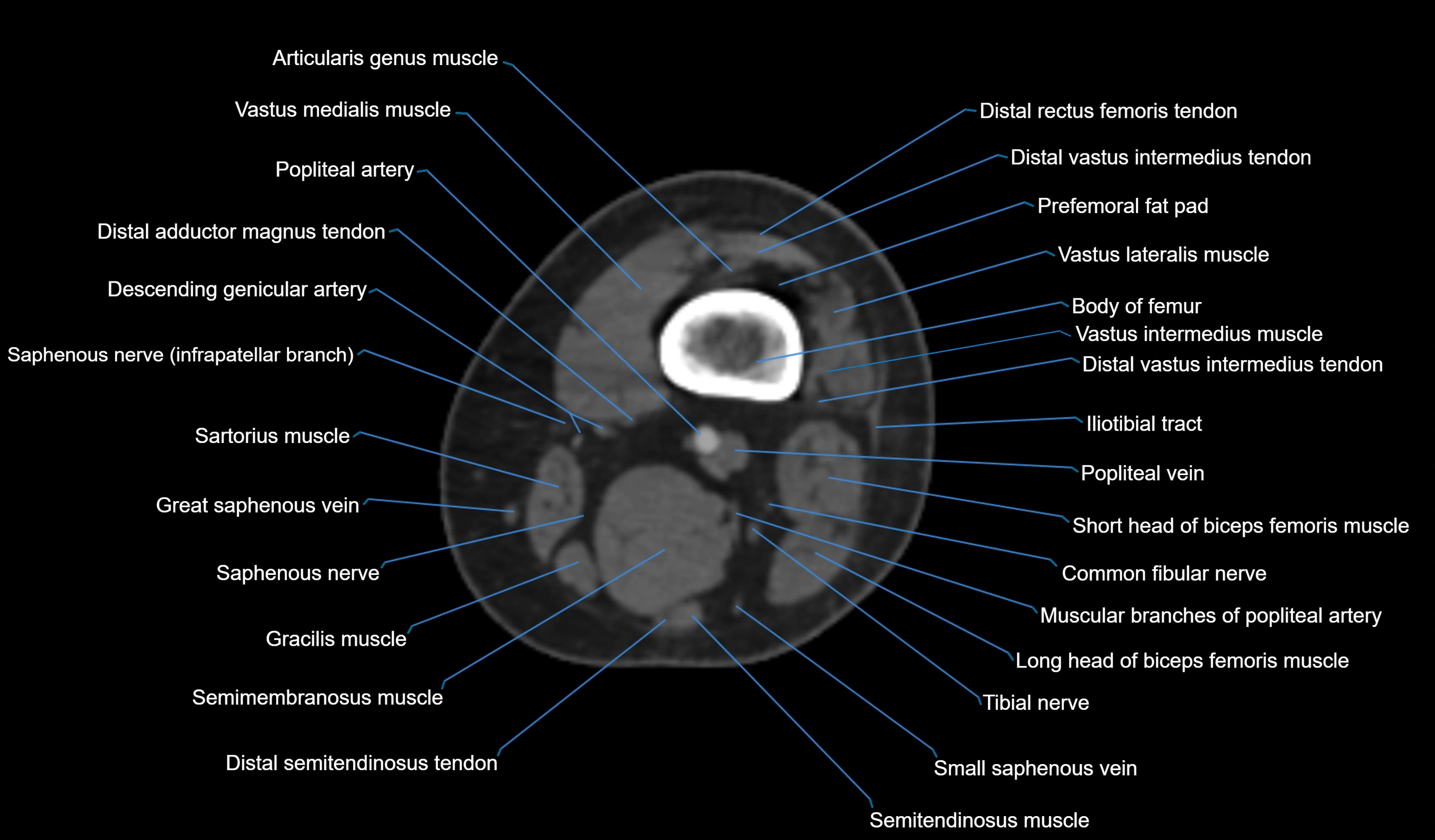 CT knee axial cross sectional anatomy labelled image-00009.webp